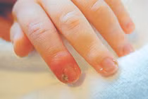 Video: 6 mẹo dân gian chữa chín mé tại nhà hiệu quả