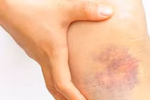 Video: 8 nguyên nhân không ngờ khiến bạn bị bầm tím cơ thể