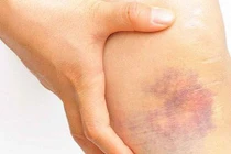 Video: 8 nguyên nhân không ngờ khiến bạn bị bầm tím cơ thể