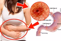 Video: Bài thuốc trị viêm loét dạ dày chỉ 7 ngày là khỏi