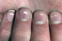 Video: Đốm trắng trên móng tay “tố” bệnh gì?