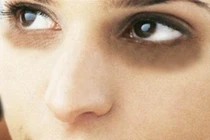 Video: Mắt thâm xì cũng hết vĩnh viễn chỉ với công thức đơn giản này