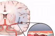 Cách điều trị thiếu máu não hiệu quả