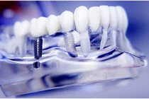 Phát minh mới - công nghệ trồng răng giả sử dụng vĩnh viễn