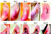 Kinh hoàng sức tàn phá của bệnh tiểu đường