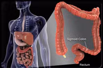 Địa chỉ nào tin cậy cho bệnh nhân ung thư đại tràng?