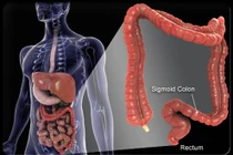 Địa chỉ nào tin cậy cho bệnh nhân ung thư đại tràng?