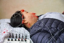 Liệt mặt do... tự ý điều trị bệnh tại nhà