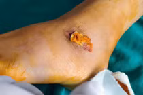 Chủ quan với vết thương nhỏ... bé trai bị suy thận và hàng loạt biến chứng