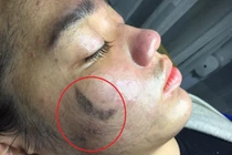 Giám đốc BV Da liễu T.Ư phân tích chiêu trò hút chì, thải độc da