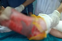 Tuyên Quang: Cảnh báo nhiều trẻ nhỏ bị bỏng nước sôi