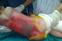 Tuyên Quang: Cảnh báo nhiều trẻ nhỏ bị bỏng nước sôi