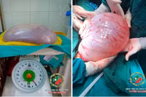 Phẫu thuật thành công cho cô gái 22 tuổi mang khối u buồng trứng gần 8kg 