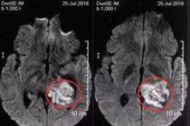 Nam sinh 18 tuổi ở Nghệ An mắc 3 bệnh ung thư cùng lúc