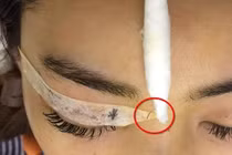 Thiếu nữ Hà Nội đi nhấn mí bị nhấn... cả kim vào mắt