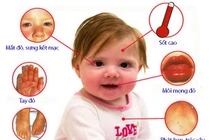 Trẻ ho sốt đừng coi thường dấu hiệu bệnh lạ nguy hiểm Kawasaki