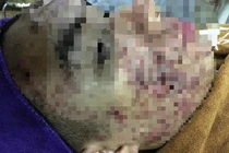 Bác sĩ phát hoảng với khuôn mặt bị "cày nát" do lăn kim làm đẹp