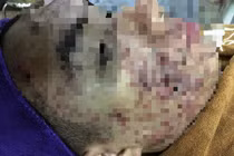 Bác sĩ phát hoảng với khuôn mặt bị "cày nát" do lăn kim làm đẹp