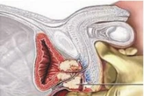 Quý ông giảm mạnh tinh dịch khi cắt tiền liệt tuyến?