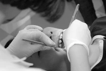 Nắn chỉnh răng bằng mắc cài mặt lưỡi 