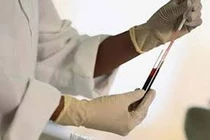 Chất chỉ điểm sinh học phát hiện sớm ung thư