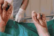 Kinh hoàng nứt toác chân vì bóng đèn huỳnh quang