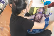 Sai lầm chết người khi chữa thủy đậu bằng cách mà nhiều người đang làm