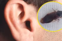 Người đàn ông phát hiện con gián ngoe nguẩy trong tai sau giấc ngủ
