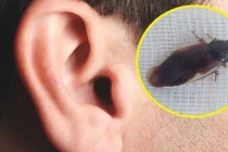 Người đàn ông phát hiện con gián ngoe nguẩy trong tai sau giấc ngủ