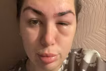 Cô gái “tá hoả” khi suýt bị mù sau lần phun xăm chân mày