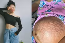 Đặng Thu Thảo bầu đôi bụng rạn chi chít, loạt sao chung cảnh ngộ