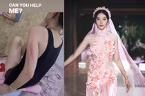 Nam Em lộ vết bầm tím trên cơ thể, oán trách ai đó