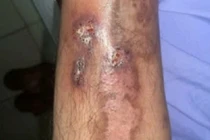 Người đàn ông lở loét chân suốt 2 năm, nấm Candida là “thủ phạm“