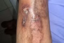 Người đàn ông lở loét chân suốt 2 năm, nấm Candida là “thủ phạm“