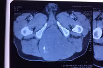 Nam bệnh nhân khốn khổ vì khối u xương cụt khủng, không thể nằm ngồi