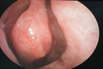 Liên tục chảy máu mũi, người đàn ông đi khám phát hiện dị vật khủng khiếp