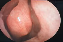 Liên tục chảy máu mũi, người đàn ông đi khám phát hiện dị vật khủng khiếp