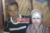 Cậu bé “người cá” suýt bị chôn sống ở Hà Giang