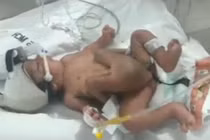 Kỳ lạ cậu bé ra đời với 4 chân, 2 "của quý"