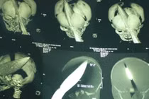 Bé trai bị đâm xuyên đầu: Đã bắt được nghi phạm