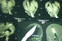 Bé trai bị đâm xuyên đầu: Đã bắt được nghi phạm