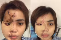 Cô gái thiếu uý tạt axit người yêu: 'Bố mẹ giấu tất cả gương soi'