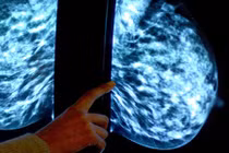 Bệnh nhân ung thư vú có thể không cần hóa trị?