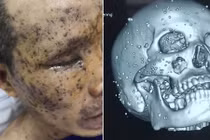 Nam công nhân bị vỡ nhãn cầu, 100 mảnh nhọn găm chi chít trên mặt