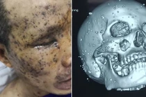 Nam công nhân bị vỡ nhãn cầu, 100 mảnh nhọn găm chi chít trên mặt