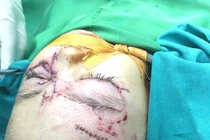 Bé gái 31 tháng tuổi bị chó nhà cắn nát mặt phải nhập viện cấp cứu