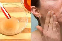 San phẳng sẹo lồi lâu năm với công thức đơn giản tại nhà