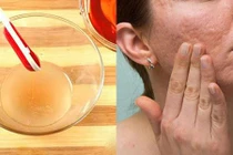 San phẳng sẹo lồi lâu năm với công thức đơn giản tại nhà