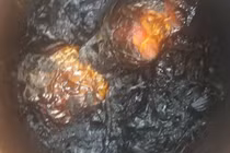 Hãi hùng xương cá đâm xuyên thực quản, lộ ra ngoài da