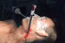 Cứu sống nam thanh niên bị thanh sắt nhọn bắn thẳng vào cổ